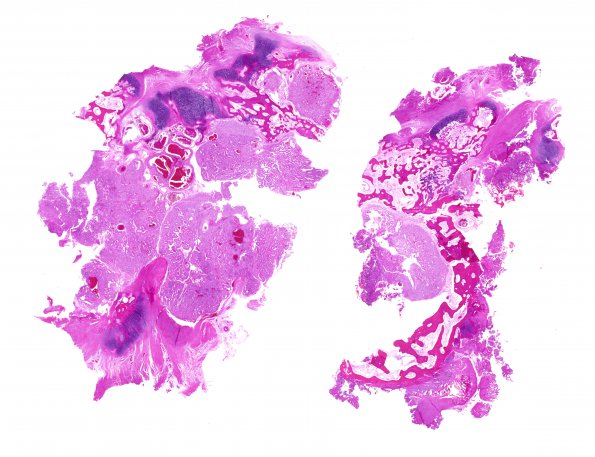 38A1 Metastasis, renal cell CA (Case 38) H&E whole mount