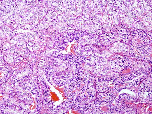 38A2 Metastasis, renal cell CA (Case 38) H&E 1