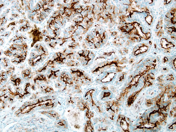 38B1 Metastasis, renal cell CA (Case 38)  CD10