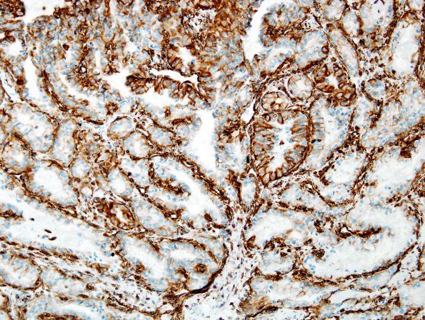 38B2 Metastasis, renal cell CA (Case 38)  Vim