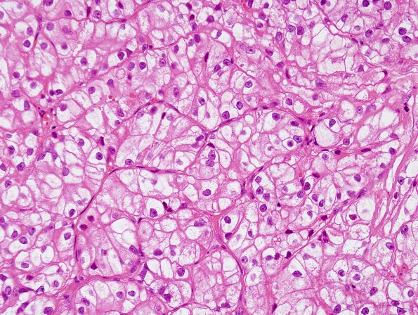 39A Metastasis, renal cell CA (Case 39) H&E 1