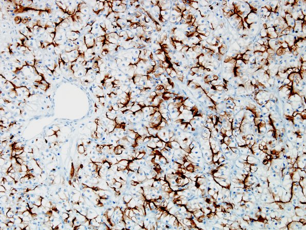 39C Metastasis, renal cell CA (Case 39) RCC