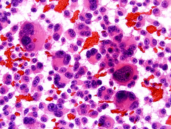 3A1 Pituitary Carcinoma, metastatic (Case 3) H&E smear 2.jpg