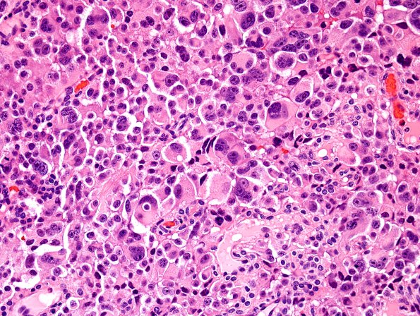 3A2 Pituitary Carcinoma, metastatic (Case 3) H&E 2.jpg