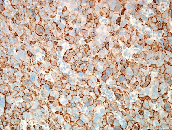 3B Pituitary Carcinoma, metastatic (Case 3) ACTH 1.jpg