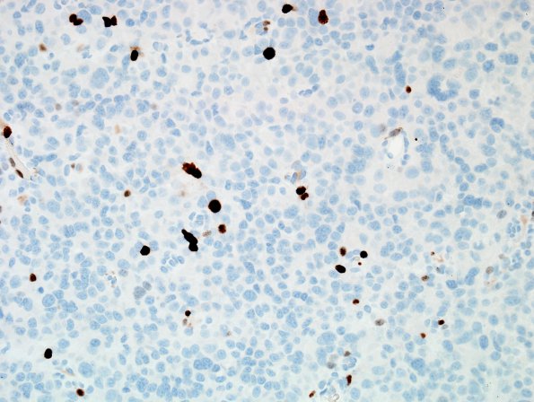 3C Pituitary Carcinoma, metastatic (Case 3) Ki67 1.jpg