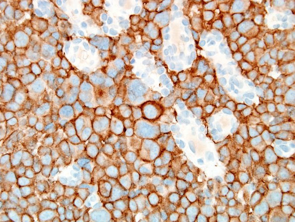 3D Pituitary Carcinoma, metastatic (Case 3) SYN 4.jpg