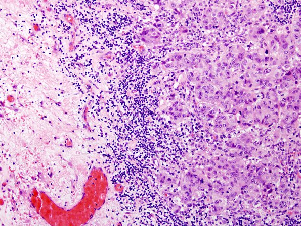 42A Metastases, adenoCA lung (Case 42) H&E