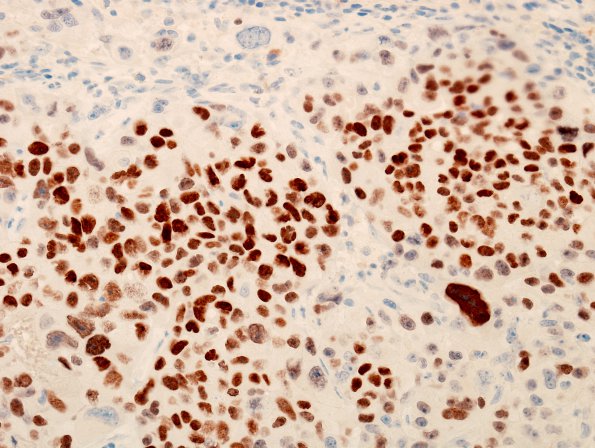 42B Metastases, adenoCA lung (Case 42) TTF-1