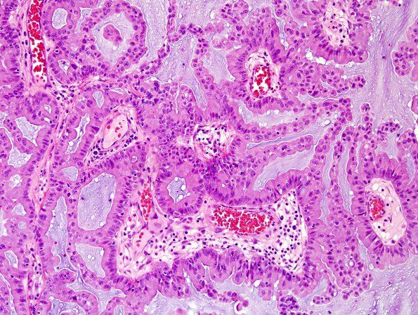 43A Metastases, adenocarcinoma, lung origin (Case 43) H&E 3.jpg