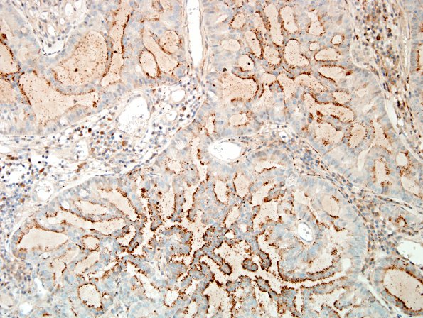 43B1 Metastases, adenocarcinoma, lung origin (Case 43) NapsinA 3.jpg