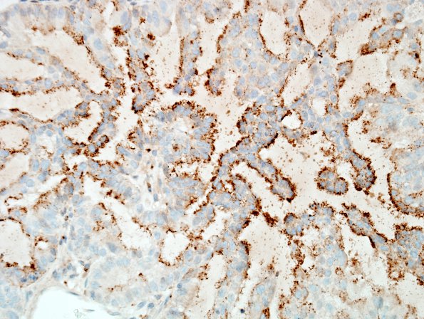 43B2 Metastases, adenocarcinoma, lung origin (Case 43) NapsinA 2-.jpg