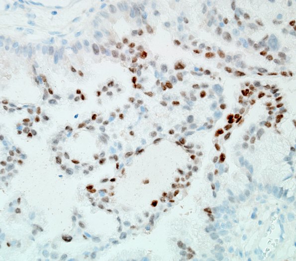 43C Metastases, adenocarcinoma, lung origin (Case 43) TTF 1.jpg