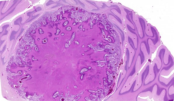 44A Metastases, lung primary (AFIP TS M9665) H&E WM