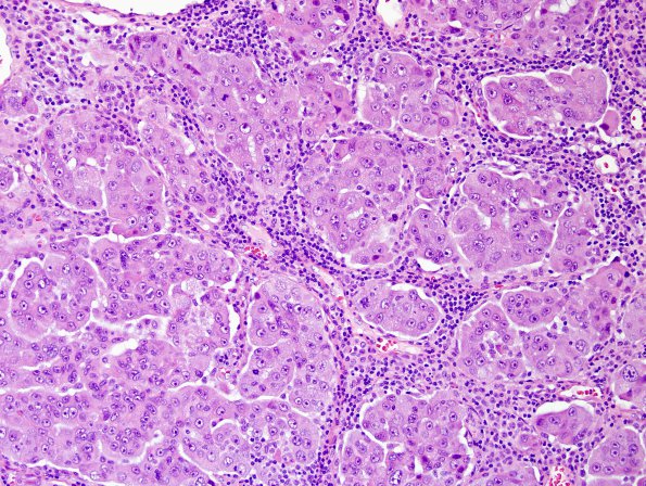 45A1 Metastasis, lung (Case 45) H&E 20X.jpg