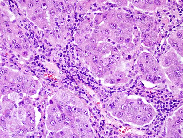 45A2 Metastasis, lung (Case 45) H&E 40X.jpg