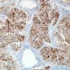 45B1 Metastasis, lung (Case 45) PD-L1 20X.jpg