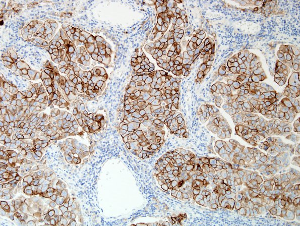 45B1 Metastasis, lung (Case 45) PD-L1 20X.jpg