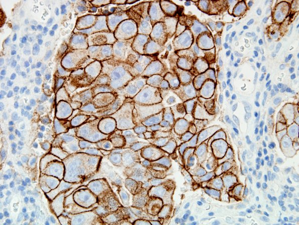 45B2 Metastasis, lung (Case 45) PD-L1 60X.jpg