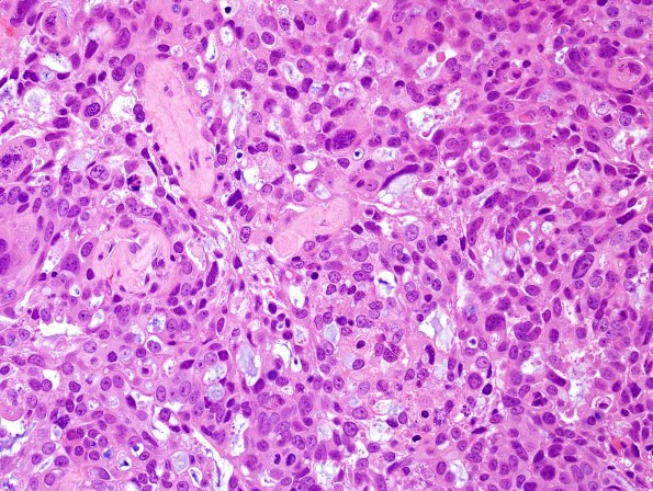 46A Metastases, lung (Case 46) H&E 1.jpg