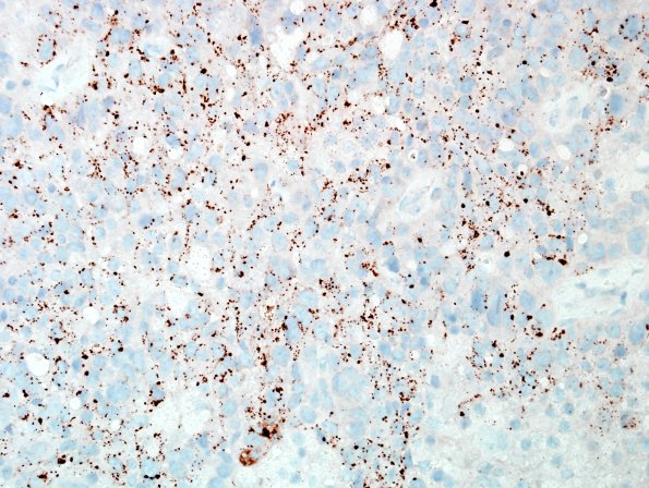 46B1 Metastases, lung (Case 46) Napsin-A 1.jpg