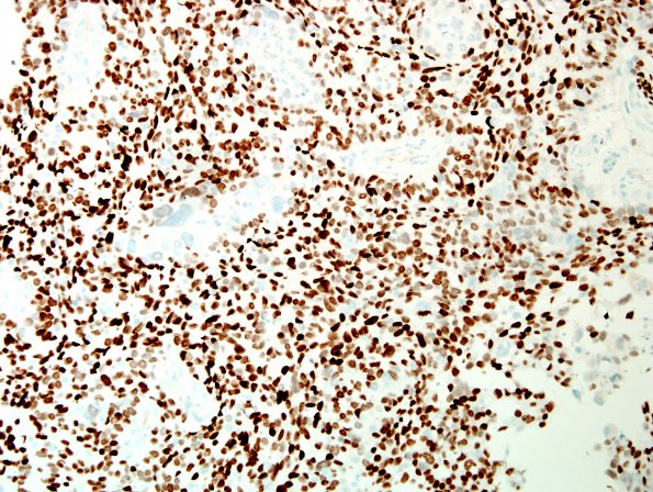 46B2 Metastases, lung (Case 46) TTF1 1.jpg