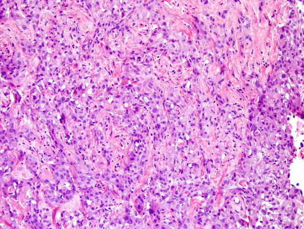 47A Metastases, lung origin (Case 47) H&E 2.jpg