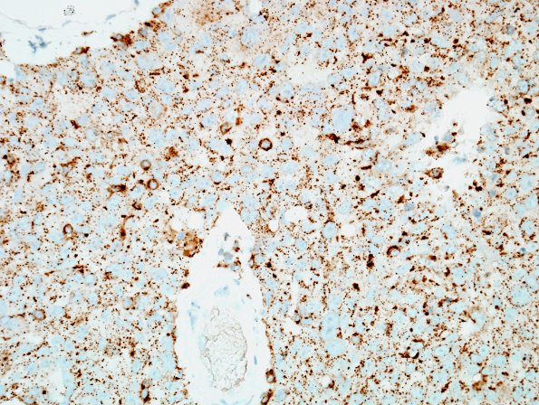 47B Metastases, lung origin (Case 47) NapsinA 1.jpg