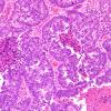 48A Metastases, lung, large cell neuroendocrine CA (Case 48) H&E 3.jpg