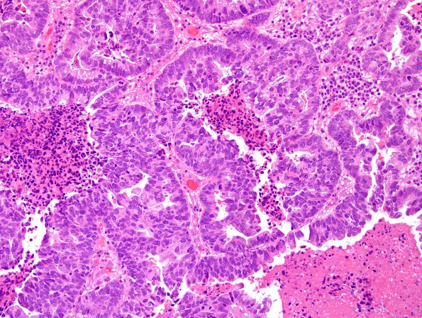 48A Metastases, lung, large cell neuroendocrine CA (Case 48) H&E 3.jpg