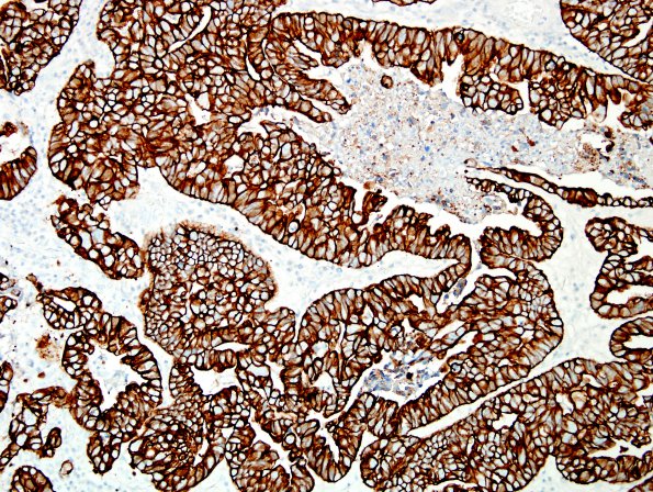 48B Metastases, lung, large cell neuroendocrine CA (Case 48) CK.jpg