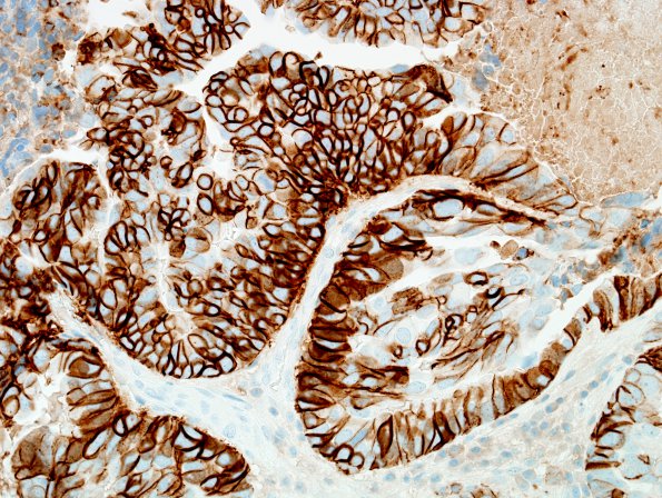 48C Metastases, lung, large cell neuroendocrine CA (Case 48) CD56 2.jpg