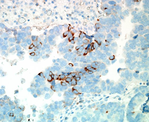 48D Metastases, lung, large cell neuroendocrine CA (Case 48) SYN 3.jpg