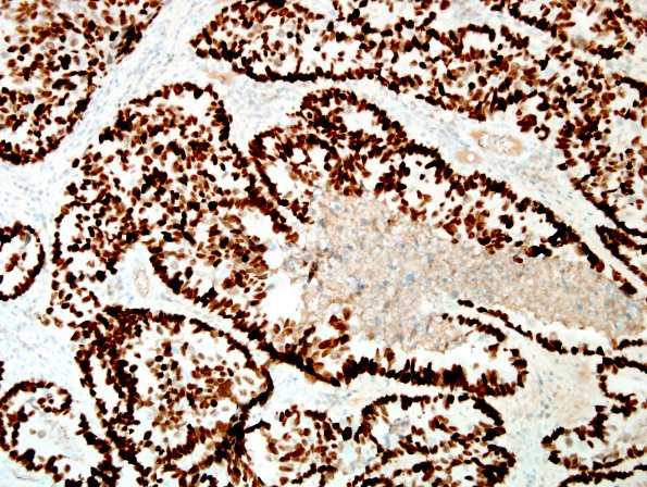 48E Metastases, lung, large cell neuroendocrine CA (Case 48) TTF1 1.jpg