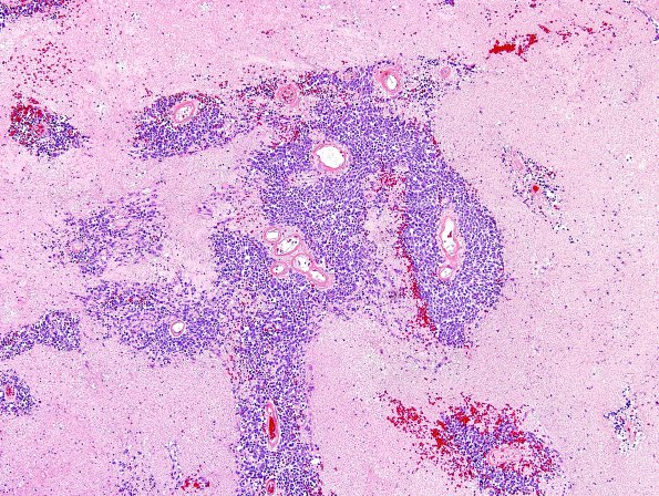 49A1 Metastases, small cell lung CA (Case 49) H&E 2