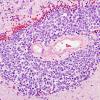 49A2 Metastases, small cell lung CA (Case 49) H&E 1 - Copy