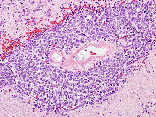 49A2 Metastases, small cell lung CA (Case 49) H&E 1 - Copy