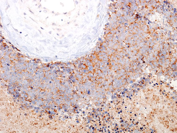 49C Metastases, small cell lung CA (Case 49) SYN