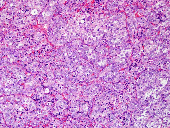 4A1 Metastases, prostate (Case 4) H&E 2.jpg