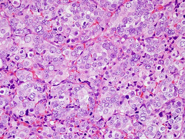 4A2 Metastases, prostate (Case 4) H&E 1.jpg