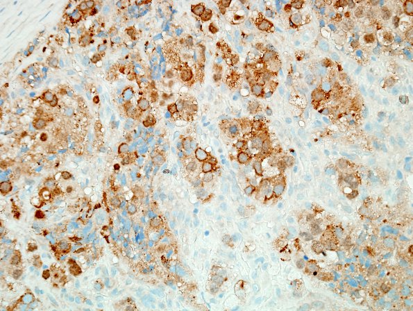 4B Metastases, prostate (Case 4) PSAP 3.jpg