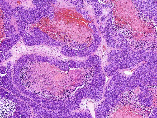 50A Metastasis lung primary (Case 50) H&E 3.jpg