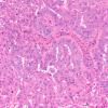51A1 Metastasis, giant cell lung CA (Case 51) H&E 6