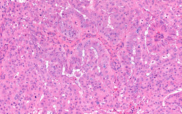 51A1 Metastasis, giant cell lung CA (Case 51) H&E 6