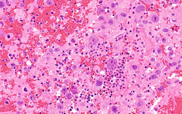 51A2 Metastasis, giant cell CA lung (Case 51) H&E 1