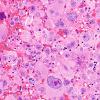 51A3 Metastasis, giant cell CA lung (Case 51) H&E 2