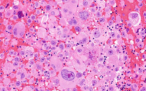 51A3 Metastasis, giant cell CA lung (Case 51) H&E 2