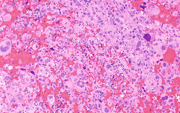 51A4 Metastasis, giant cell CA lung (Case 51) H&E 3