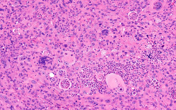 51A5 Metastasis, giant cell lung CA (Case 51) H&E 2