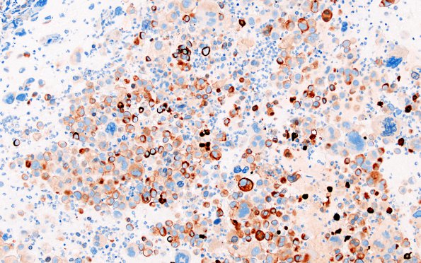 51B1 Metastasis, giant cell CA lung (Case 51) CAM52 3